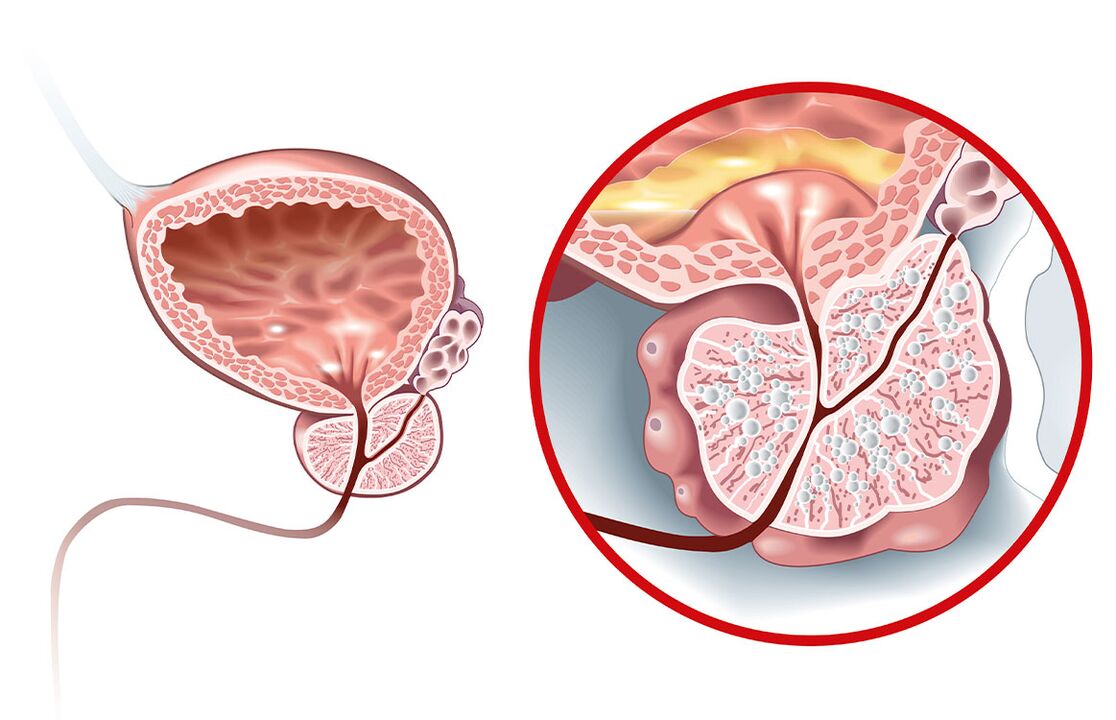 Cosa succede alla prostata con adenoma e prostatite