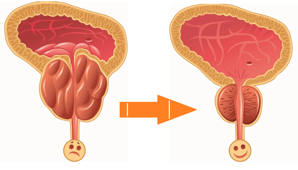 Effetto di Uromexil Forte sulla prostata con prostatite e adenoma